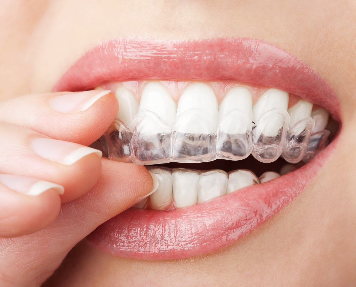 Jak rychle vybělit zuby?